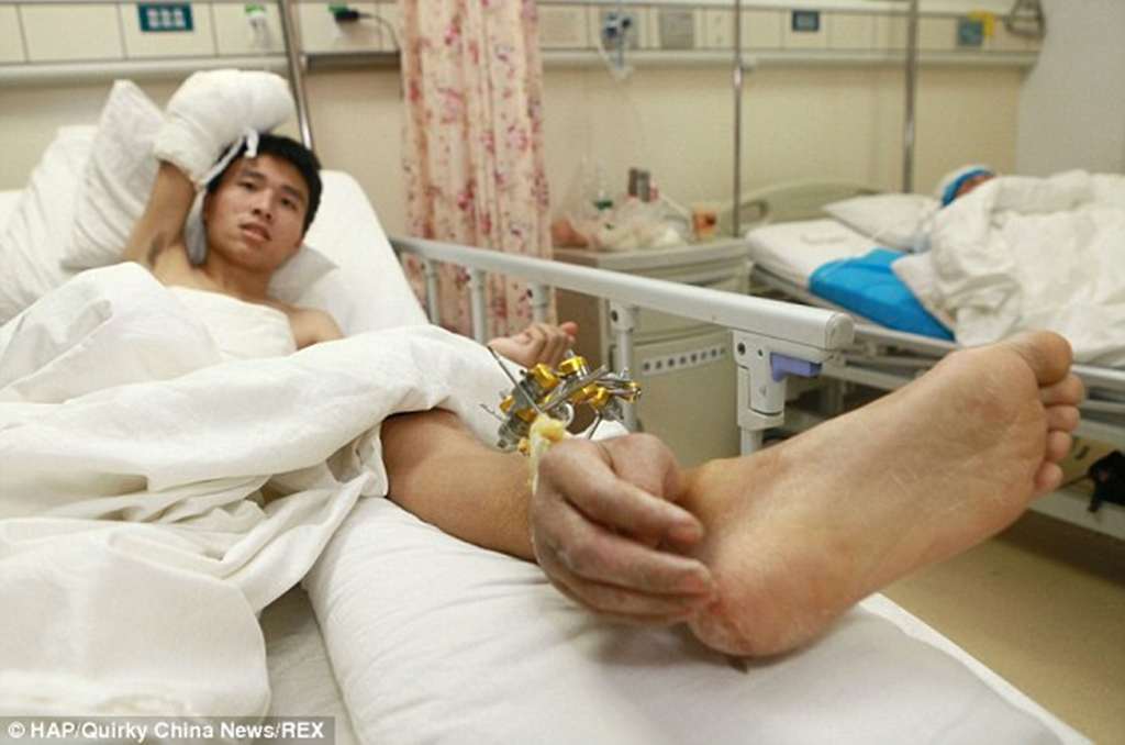 Китайские врачи пришили оторванную кисть к лодыжке пациента